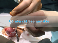 Bao quy đầu bình thường có nên cắt không