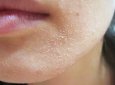 8 biện pháp khắc phục tại nhà cho da khô nghiêm trọng