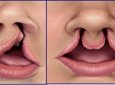 Nguyên nhân và cách điều trị hở hàm ếch và sứt môi