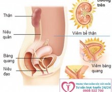 Biến chứng nguy hiểm của nhiễm trùng đường tiểu ở nam giới