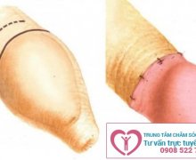 Bị dài bao quy đầu có nên cắt không?