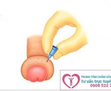 Bao quy đầu bị sưng phồng lên như cục mỡ là do đâu ?