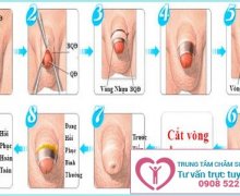 Cắt bao quy đầu ở đâu tại Bình Dương?