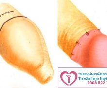 Có nên cắt bao quy đầu hay không?