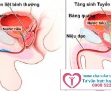 Đi tiểu nhiều lần và đau bụng dưới là biểu hiện bệnh gì?