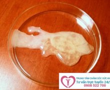 Tinh trùng có màu bất thường là dấu hiệu của bệnh gì?