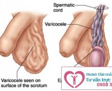 Dấu hiệu của giãn tĩnh mạch thừng tinh