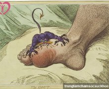 Bệnh gout và những biến chứng của gout
