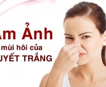 Huyết trắng có mùi hôi và ngứa là bệnh gì, nguy hiểm không?