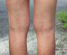 Thuốc trị mề đay bằng vảy của tê tê có được không?