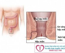 Một số hình ảnh bệnh trĩ thường gặp