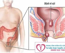 Chi phí chữa trĩ ngoại có nhiều không?
