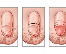 Cách phòng tránh cắt bao quy đầu mà không bị nhiễm sùi mào gà?