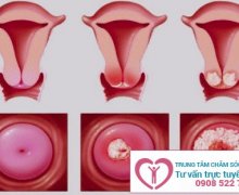 Làm sao để nhận biết viêm lộ tuyến cổ tử cung