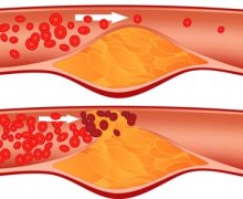 Cholesterol tăng cao nguy hiểm như thế nào