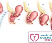 Địa chỉ điều trị bệnh sa tử cung ở nữ giới