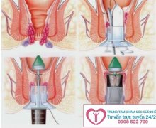 Cắt trĩ bằng laser bao nhiêu tiền