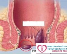 Bật mí cách chữa trĩ ngoại cực kỳ hiệu quả