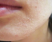 8 biện pháp khắc phục tại nhà cho da khô nghiêm trọng