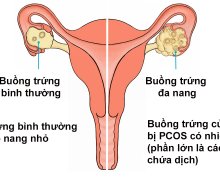 Bệnh đa nang buồng trứng có thai được không?