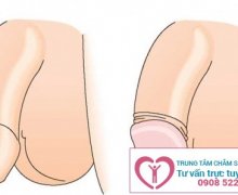 Dấu hiệu và biểu hiện nhận biết dài bao quy đầu