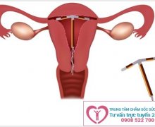 Đặt vòng tránh thai có đau hay gây ảnh hưởng gì không?