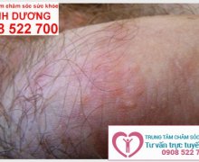 Dấu hiệu bệnh sùi mào gà giai đoạn đầu ở nam và nữ