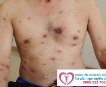 Bệnh giang mai - triệu chứng và cách điều trị hiệu quả nhất