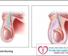 Dấu hiệu nhận biết tràn dịch màng tinh hoàn