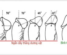 Tiểu phẫu chỉnh hình dây chằng bao quy đầu bao nhiêu tiền?