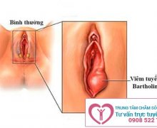 Địa chỉ khám chữa viêm tuyến Bartholin tốt nhất