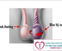 Biểu hiện và tác hại của viêm mào tinh hoàn ở nam giới