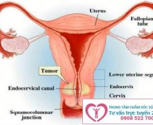 Tử cung bất thường - nguyên nhân gây vô sinh chính ở nữ giới