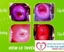 Viêm lộ tuyến cổ tử cung độ 1, 2, 3
