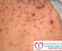 Giang mai và những mối nguy hiểm khó lường