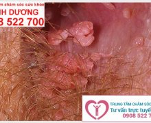 Hình ảnh bệnh sùi mào gà giai đoạn đầu ở nam và nữ