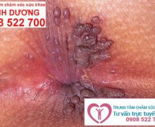 Sùi mào gà ở hậu môn có sao không?