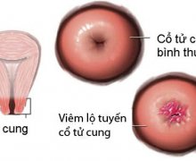 Hình ảnh cổ tử cung bình thường