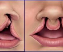 Nguyên nhân và cách điều trị hở hàm ếch và sứt môi
