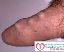 Mất bao nhiêu tiền mới có thể tiến hành gắn bi dương vật?