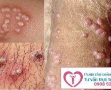 Nguyên nhân gây ra bệnh mụn rộp sinh dục tái phát