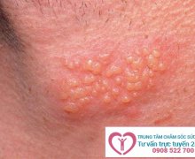 Mụn rộp sinh dục có tái phát không?