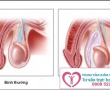 Bệnh sa tinh hoàn có nguy hiểm không?