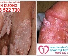 Nguyên nhân, triệu chứng của bệnh sùi mào gà ở nam và nữ