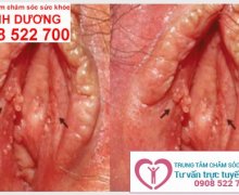 Bệnh sùi mào gà có chữa được không? Điều trị bằng cách nào?