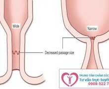 Hẹp hậu môn và phương pháp điều trị
