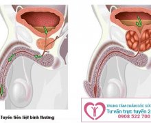 Địa chữa chữa phì đại tuyến tiền liệt tại Bình Dương