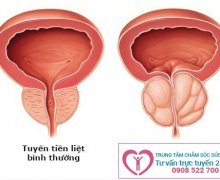 Tổng quan về bệnh phình tuyến tiền liệt