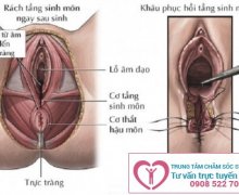 Rách âm đạo và những nguy hiểm chị em cần biết