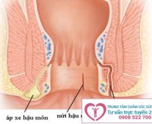 Nguyên nhân, triệu chứng bệnh rò hậu môn